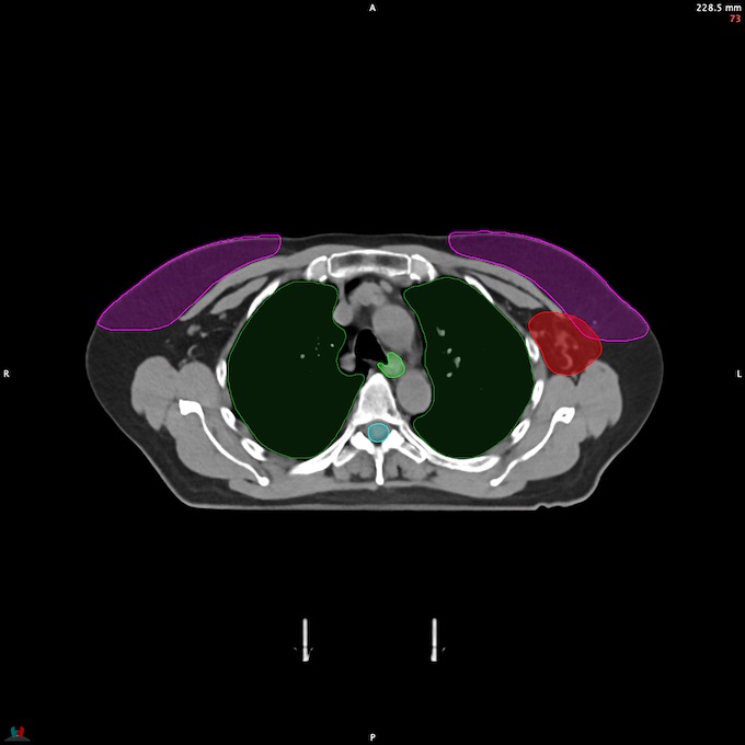 CT__SPINALCORD_57