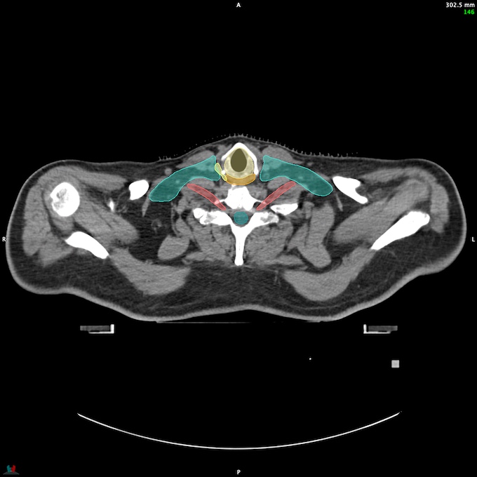 CT__SPINALCORD_57