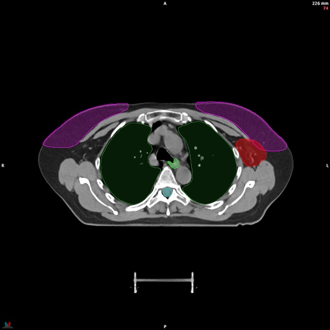 CT__SPINALCORD_58