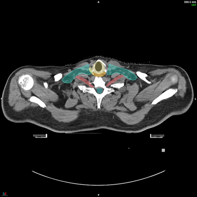 CT__SPINALCORD_58