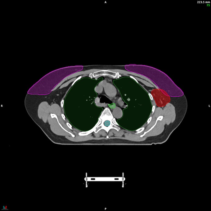 CT__SPINALCORD_59