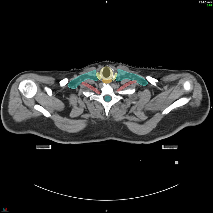 CT__SPINALCORD_59