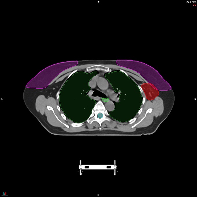 CT__SPINALCORD_60