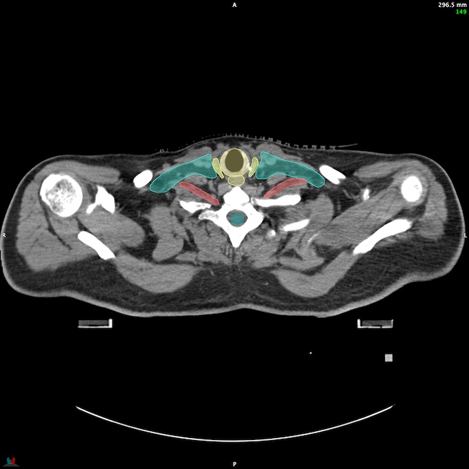 CT__SPINALCORD_60