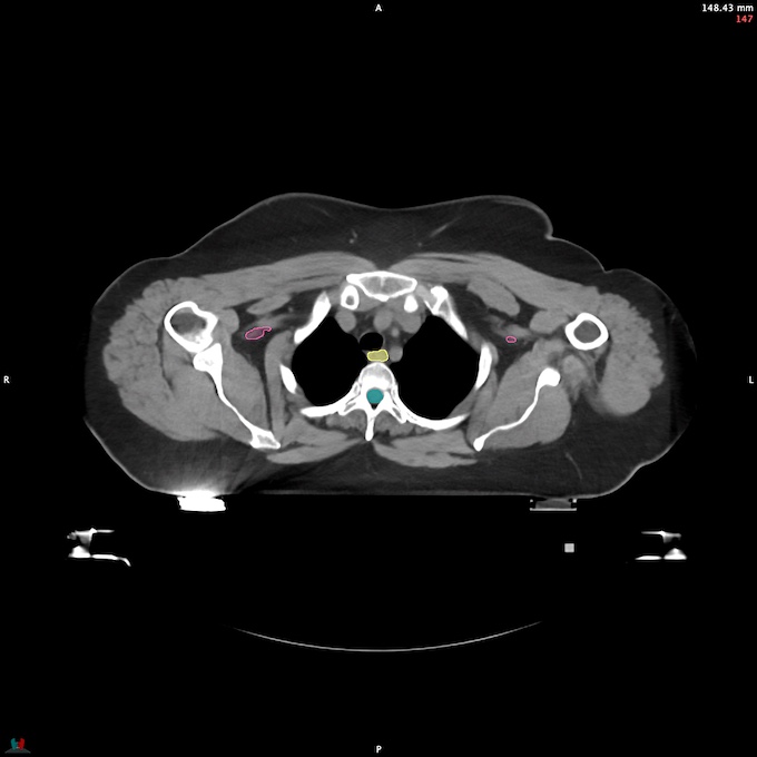 CT__SPINALCORD_60