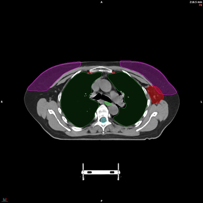 CT__SPINALCORD_61