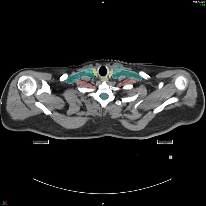 CT__SPINALCORD_61