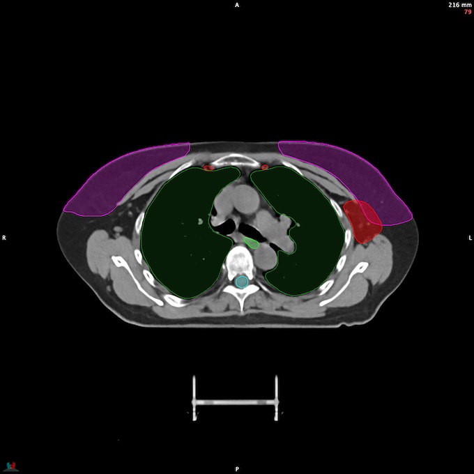 CT__SPINALCORD_62