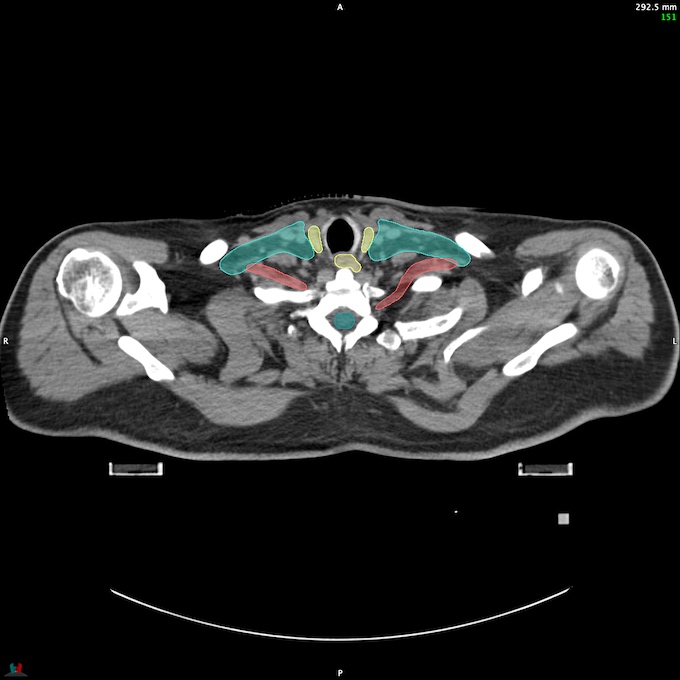 CT__SPINALCORD_62