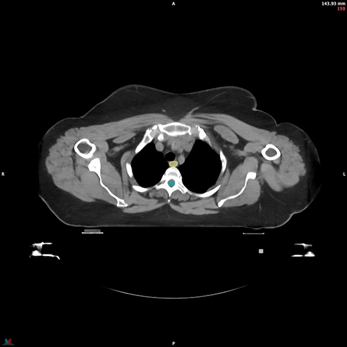 CT__SPINALCORD_62