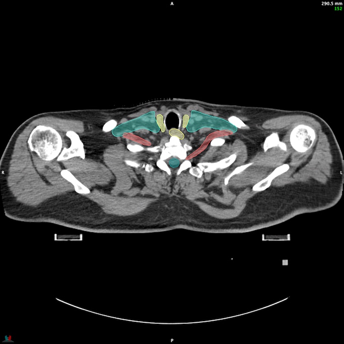 CT__SPINALCORD_63