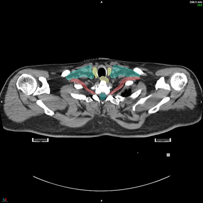 CT__SPINALCORD_64