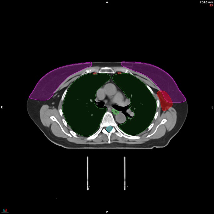 CT__SPINALCORD_65