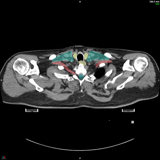 CT__SPINALCORD_65