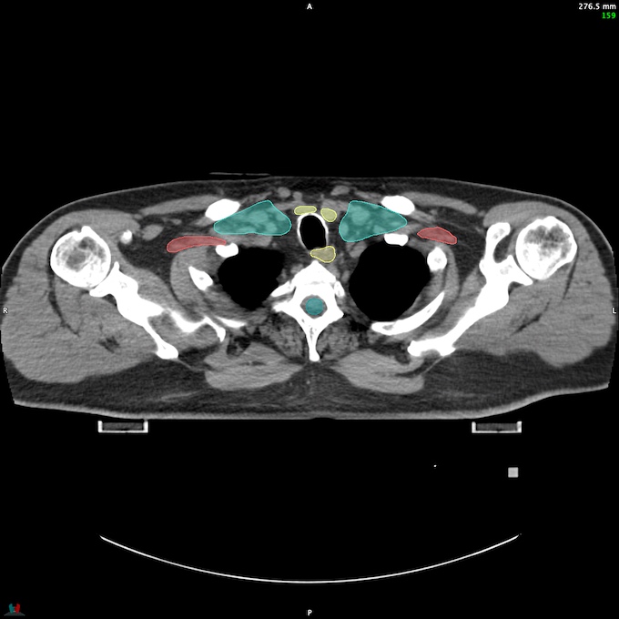 CT__SPINALCORD_70