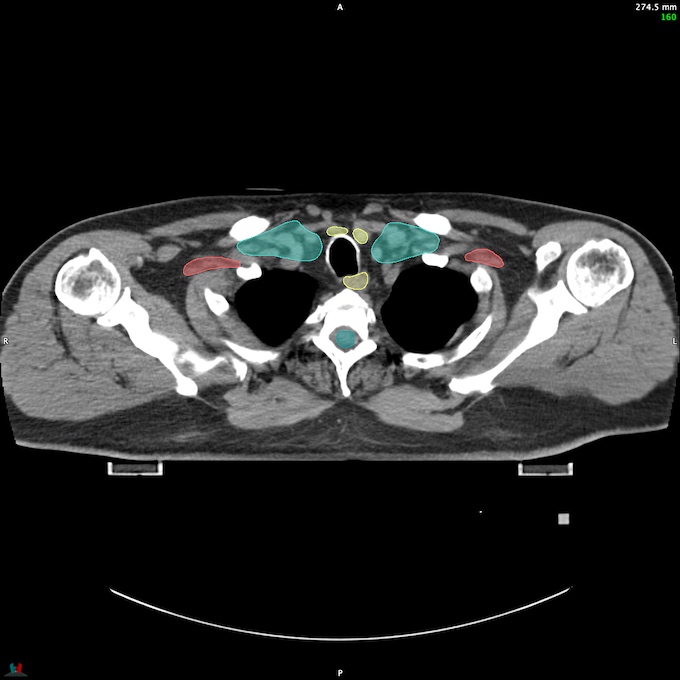 CT__SPINALCORD_71