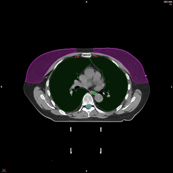 CT__SPINALCORD_72