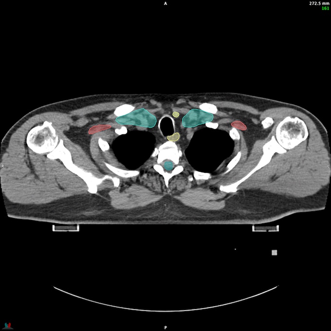 CT__SPINALCORD_72