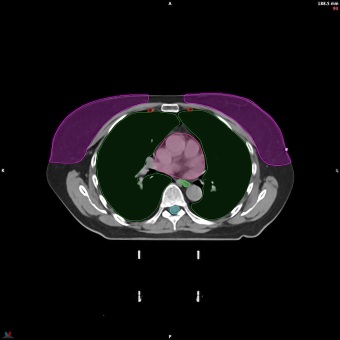 CT__SPINALCORD_73