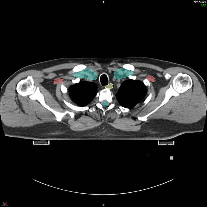 CT__SPINALCORD_73