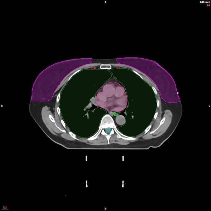 CT__SPINALCORD_74