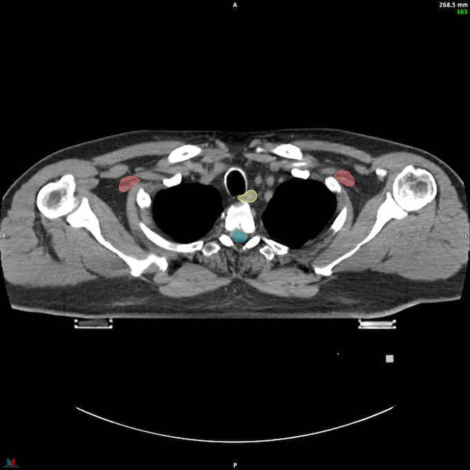 CT__SPINALCORD_74