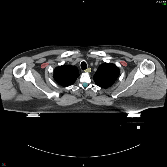 CT__SPINALCORD_75