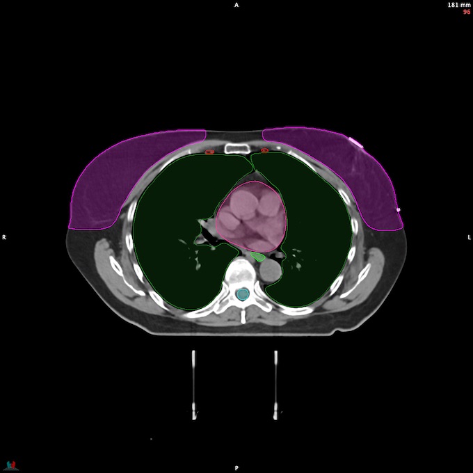 CT__SPINALCORD_76