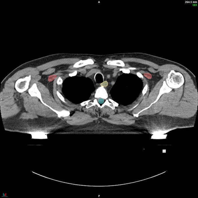 CT__SPINALCORD_76