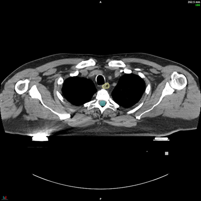 CT__SPINALCORD_77