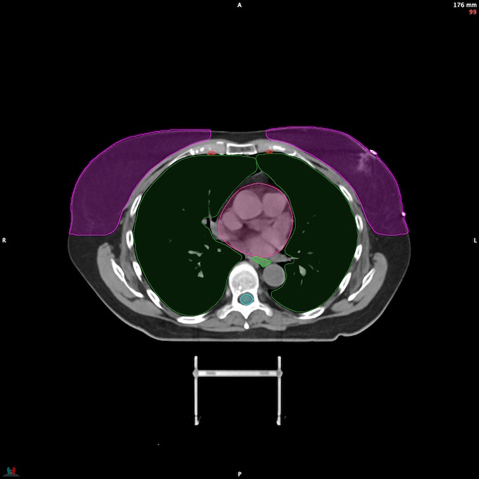 CT__SPINALCORD_78