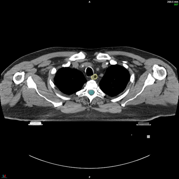 CT__SPINALCORD_78