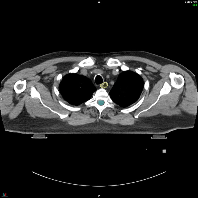 CT__SPINALCORD_79