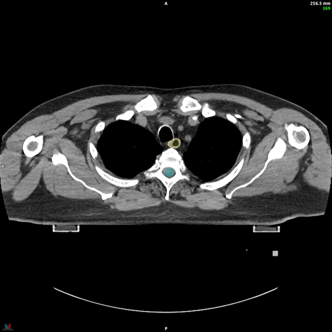 CT__SPINALCORD_80