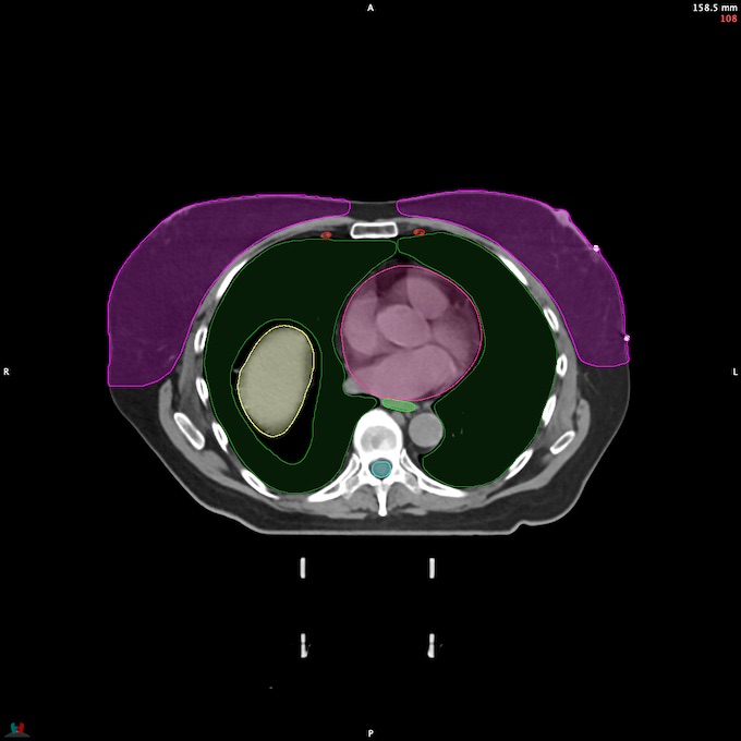 CT__SPINALCORD_85