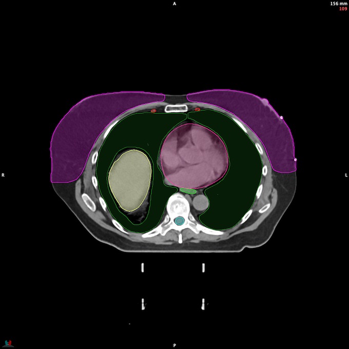 CT__SPINALCORD_86