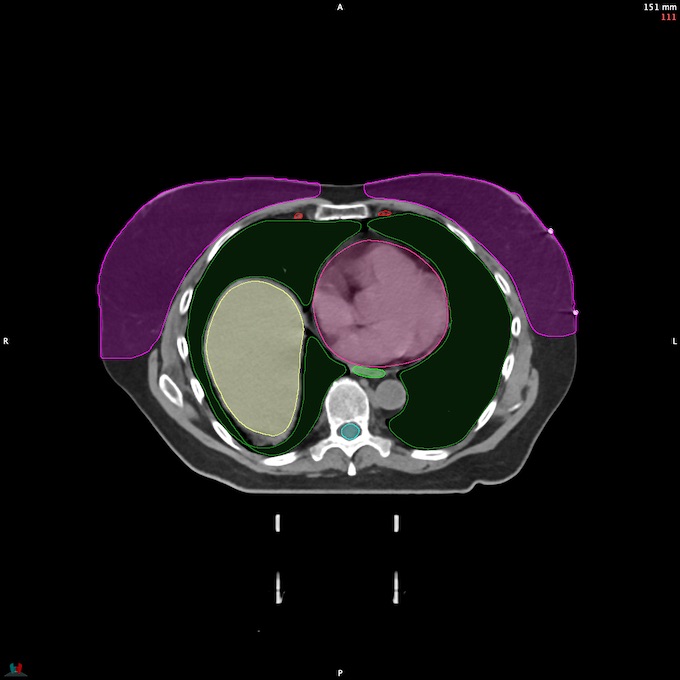 CT__SPINALCORD_88