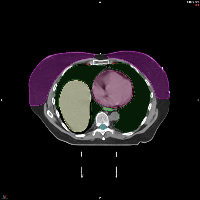 CT__SPINALCORD_89