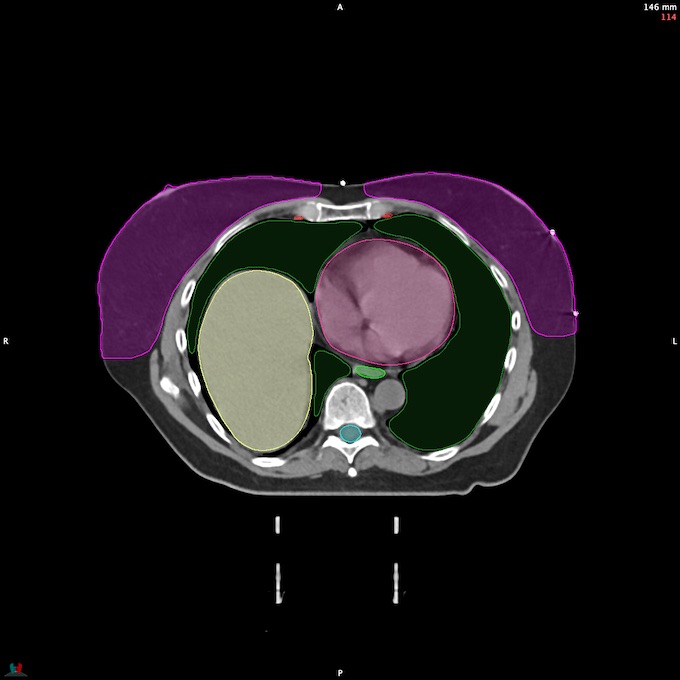 CT__SPINALCORD_90