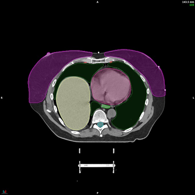 CT__SPINALCORD_91