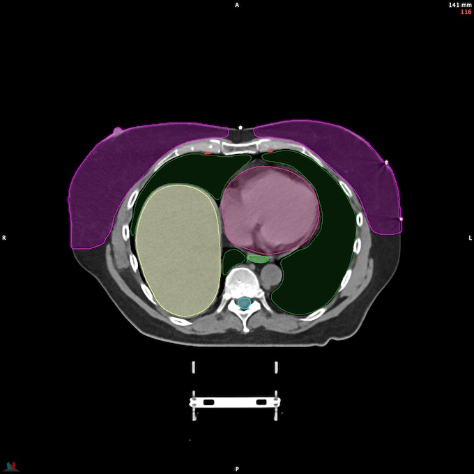 CT__SPINALCORD_92