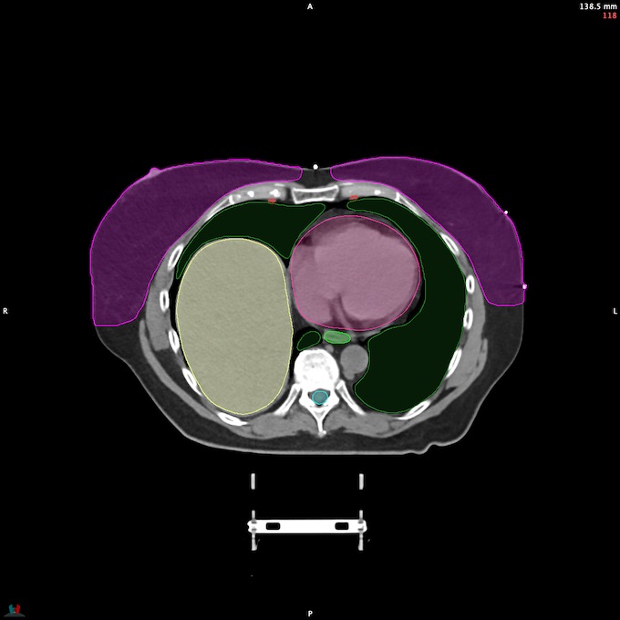 CT__SPINALCORD_93